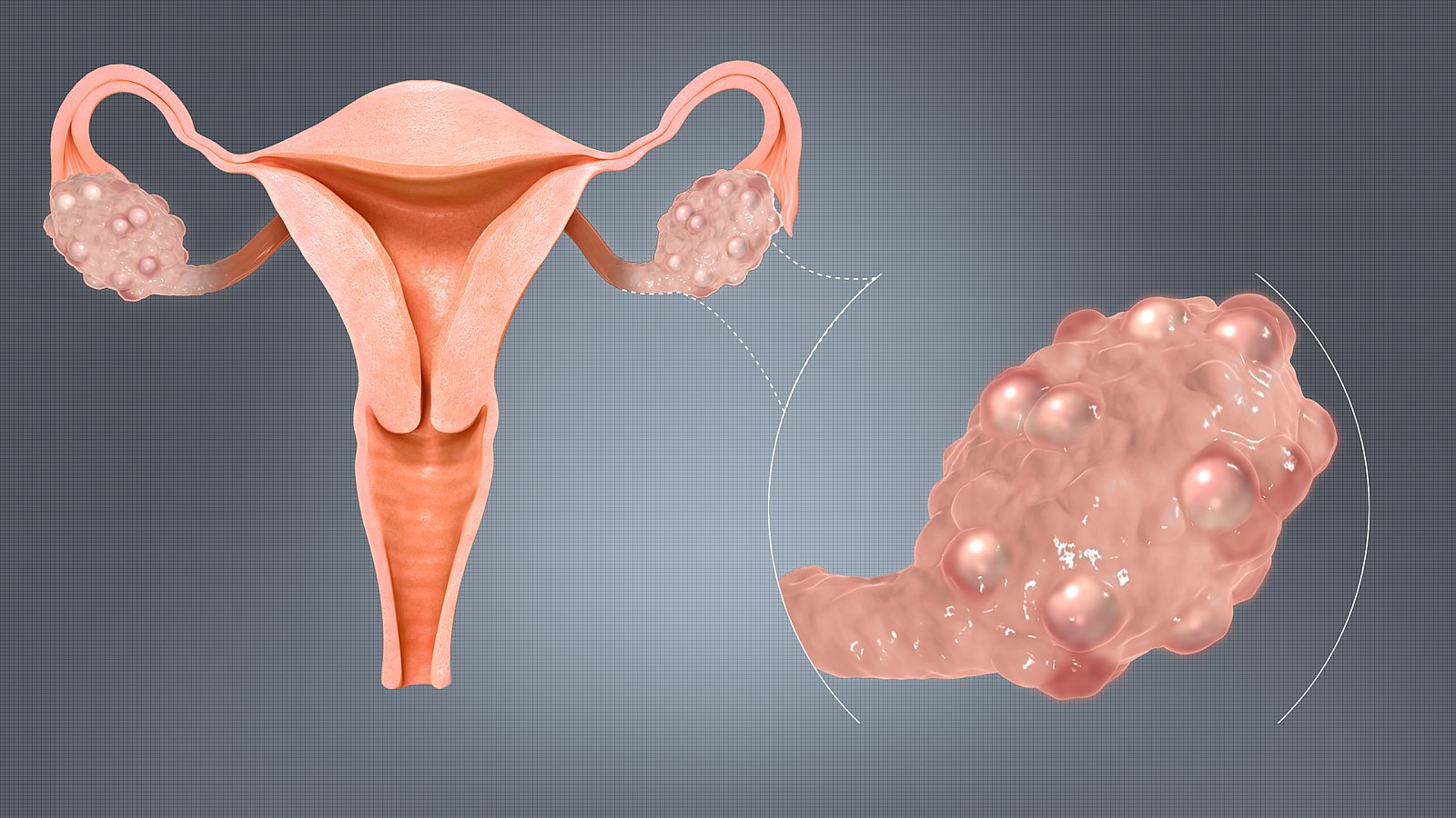 Treating PCOS Naturally – Polycystic Ovary Syndrome