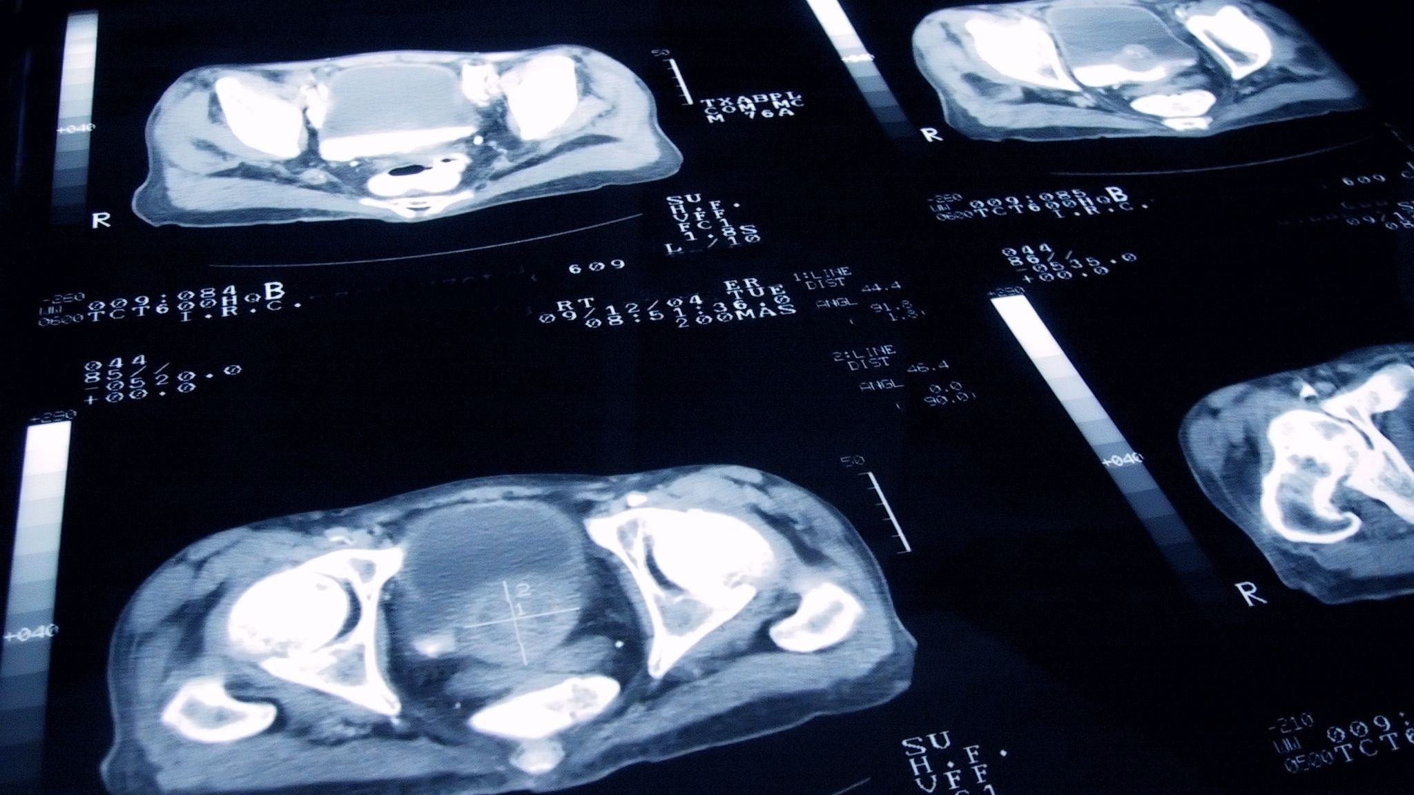 Prostate cancer: Deaths could be 'significantly reduced' by using MRI scans, study suggests